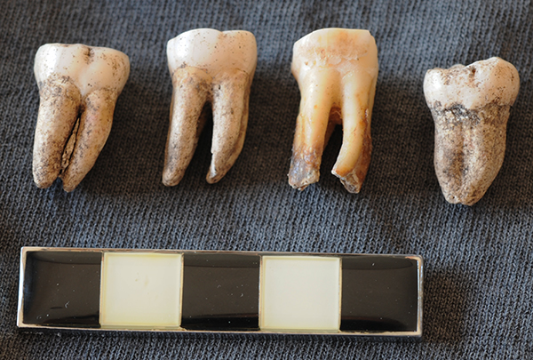 Aboriginal mandibular molars